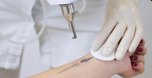 Clareamento ou Remoção de Tatuagens